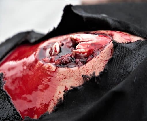 Reisiluun avomurtuma - Image 3